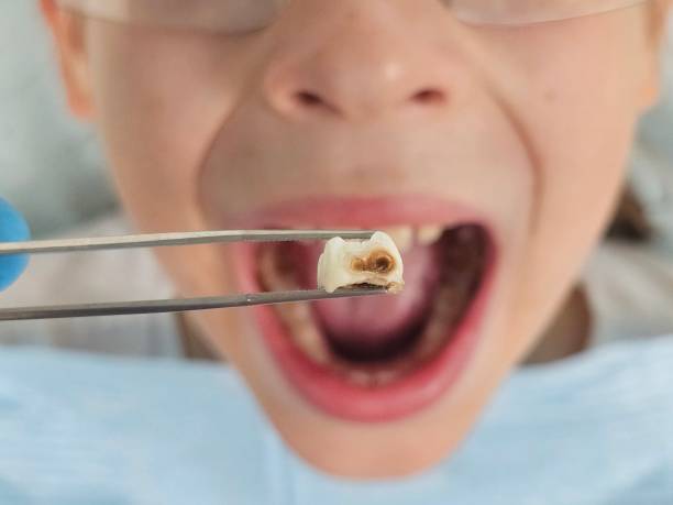 Best Emergency Tooth Extraction in Rosamond, CA